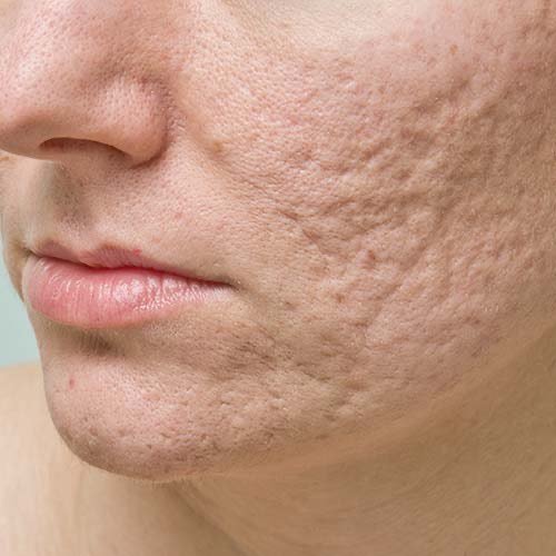 Acne Scars